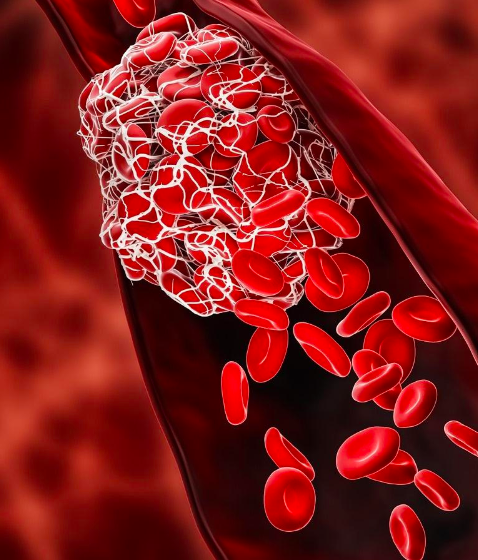 What Causes COVID-19 Blood Clots